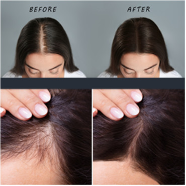 Rolylind OS Treatment for hair loss shampoo & hair growth serum combos- 5 Pcs (Serum­ 4x50ml + Shampoo 1x400ml)